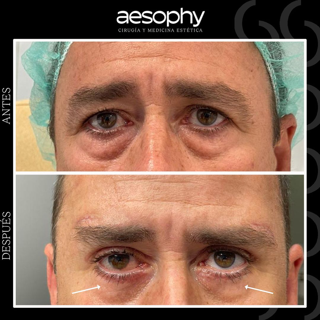 Blepharoplasty Málaga: Youthful and Rejuvenated Look Aesophy