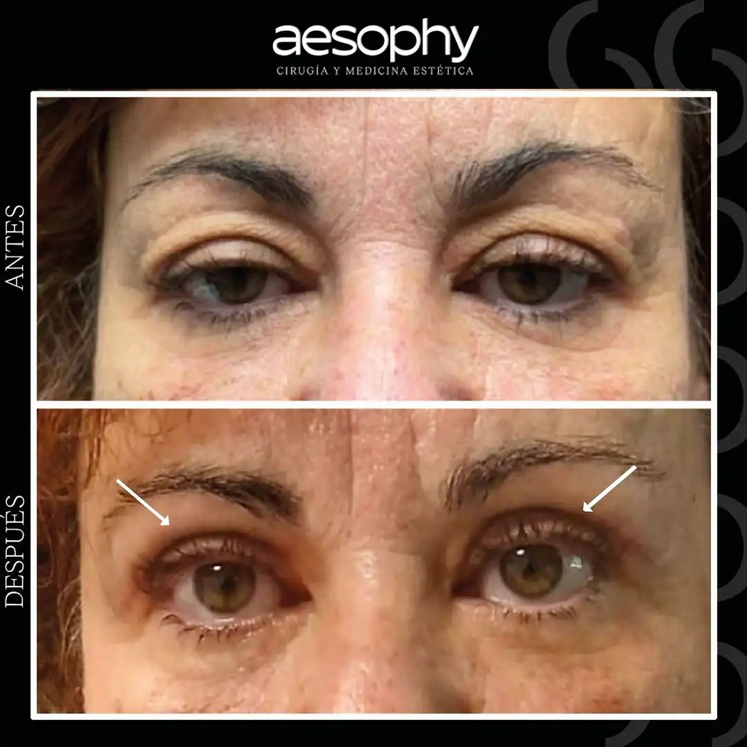 Blepharoplasty Málaga: Youthful and Rejuvenated Look Aesophy