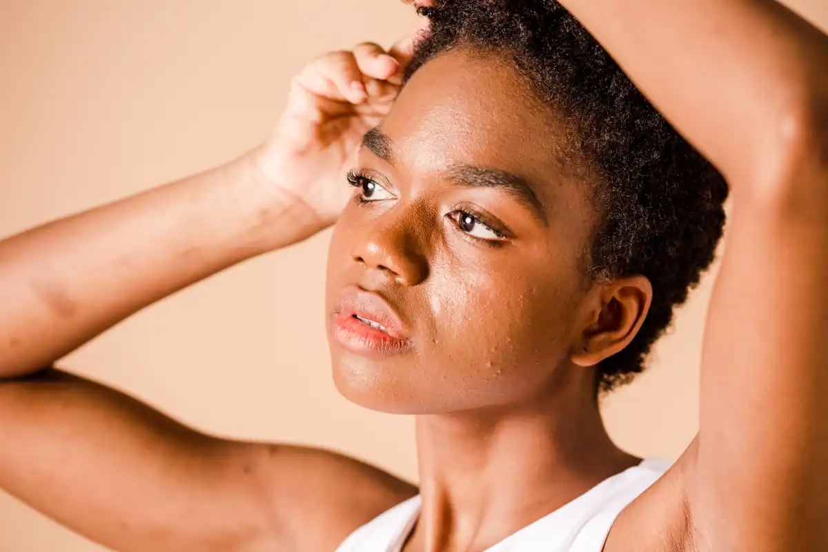 Tratamiento peeling ácido tricloroacético (TCA) Clínica Aesophy