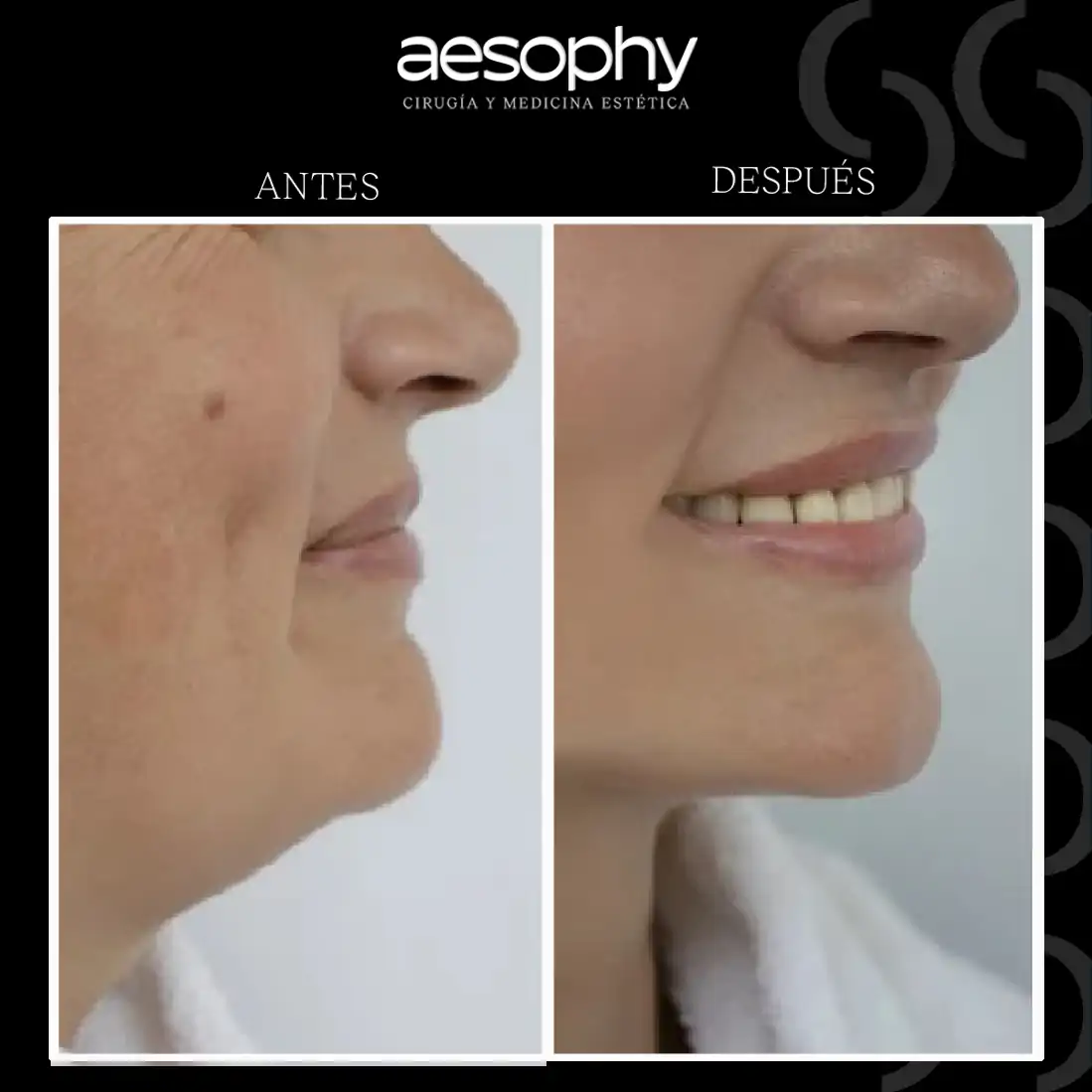 antes y después de eliiminacón de papada Clínica Aesophy