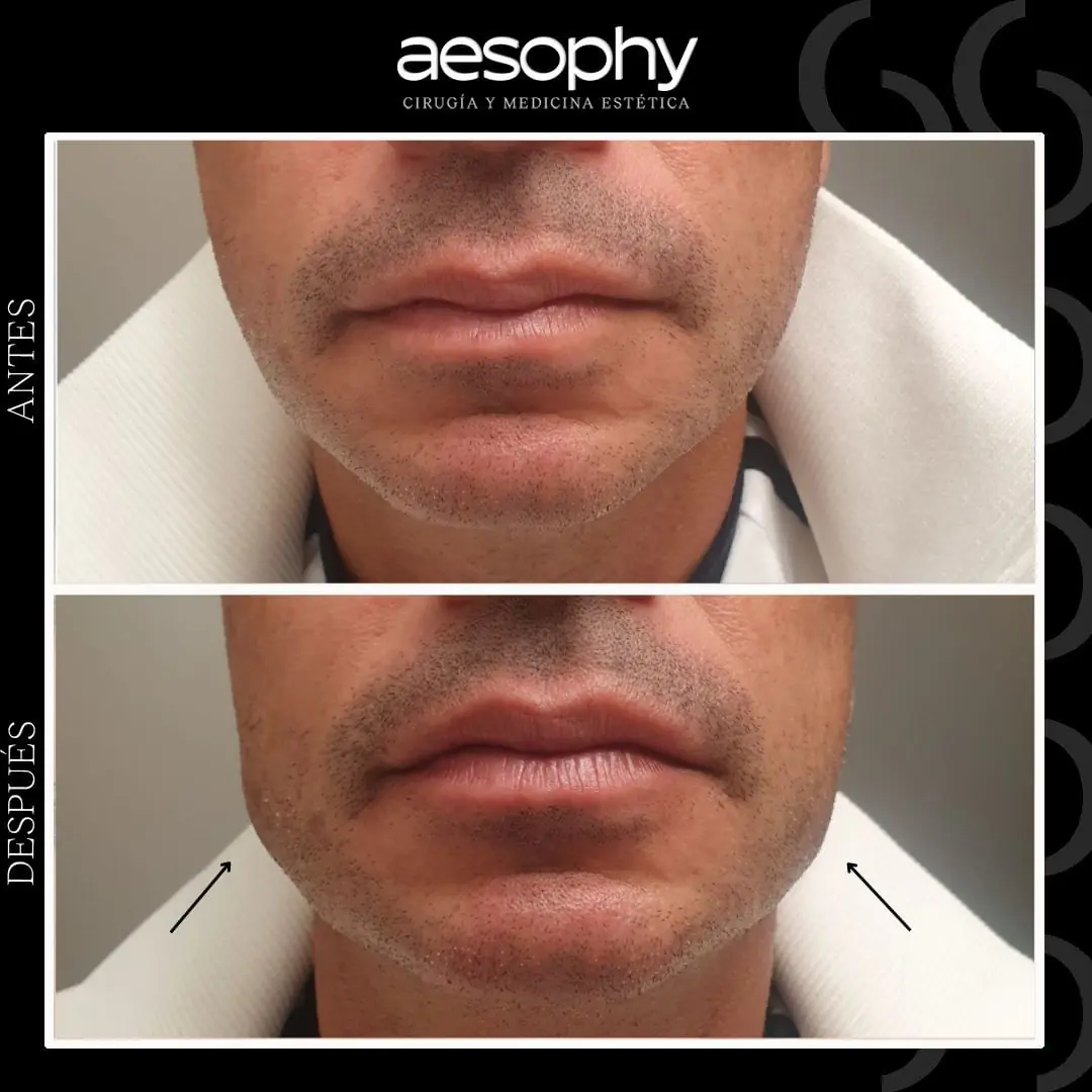 Antes y después Masculinización Facial Málaga Clínica Aesophy