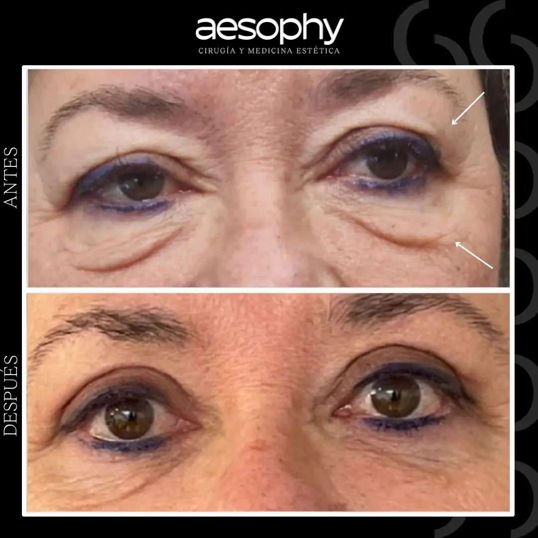 Blepharoplasty Málaga: Youthful and Rejuvenated Look Aesophy