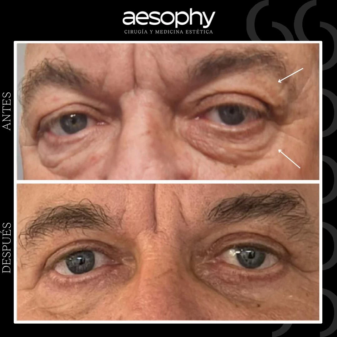 Blepharoplasty Málaga: Youthful and Rejuvenated Look Aesophy